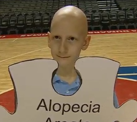 Children's Alopecia Areata Baldness Dallas TX
