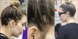 Read more about the article Hair Extensions & Traction Alopecia